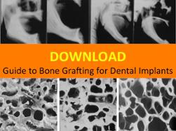 Download Guide to Bone Grafting for Dental Implants