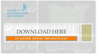 CT guided dental implant