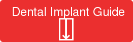 Dental Implant Guide ⍗