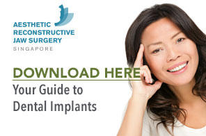 dental implants singapore