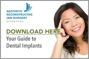 dental implants singapore